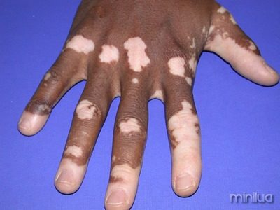 banner_vitiligo